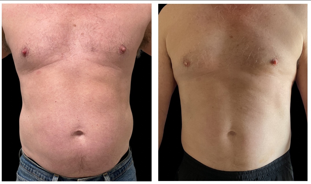 Emerald Laser™ Before and After Pictures Monroe, LA and Southlake, TX