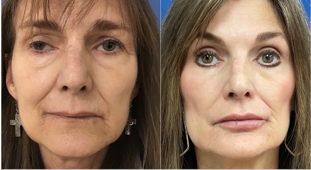 Liquid Facelift Before and After Pictures Monroe, LA and Southlake, TX